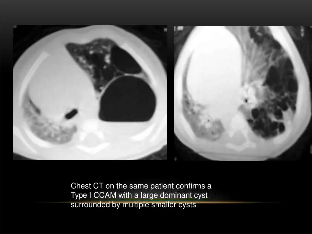 chest ct on the same patient confirms a type
