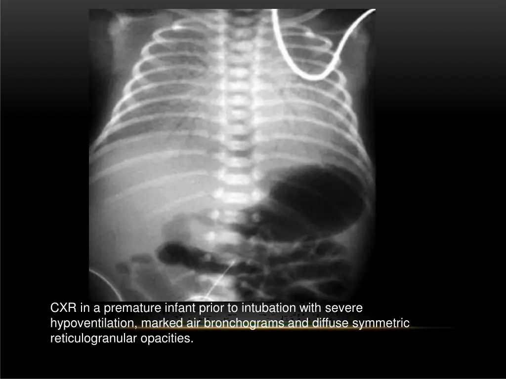 cxr in a premature infant prior to intubation