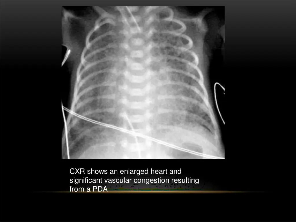 cxr shows an enlarged heart and significant