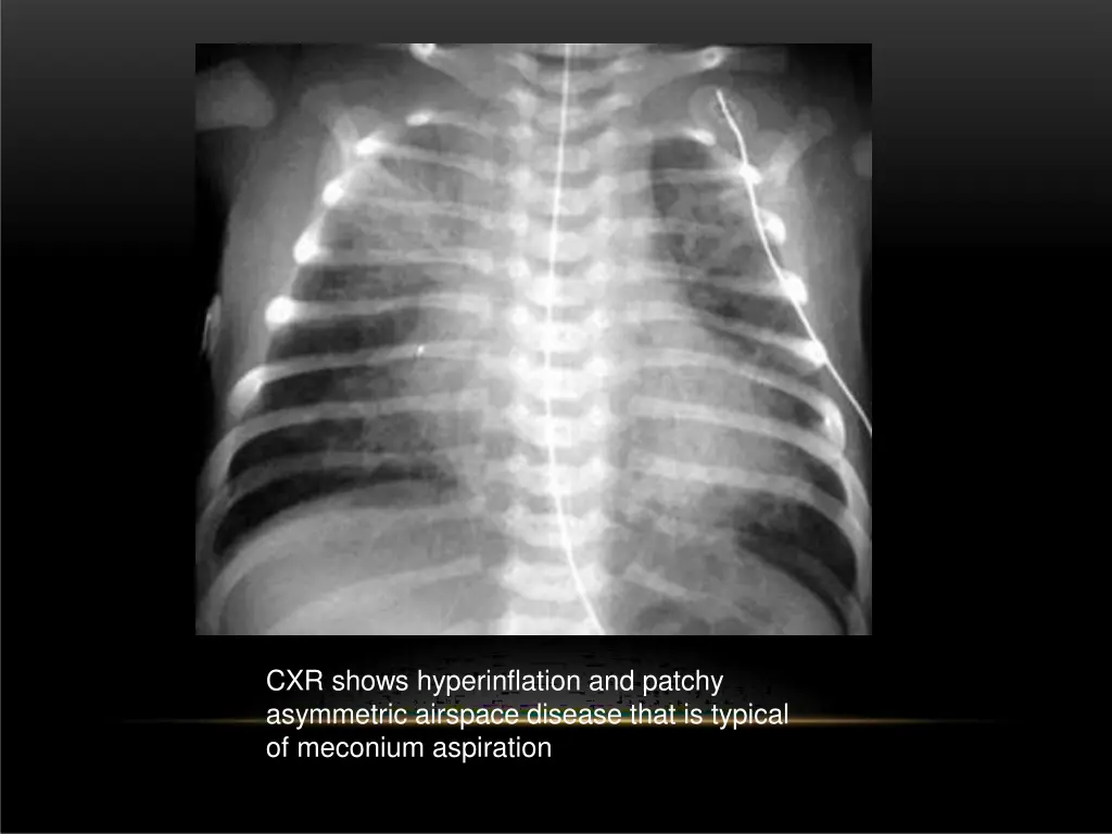 cxr shows hyperinflation and patchy asymmetric