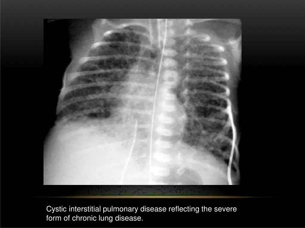 cystic interstitial pulmonary disease reflecting