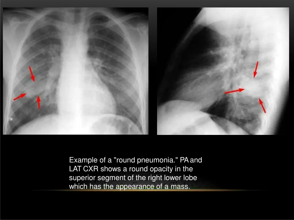example of a round pneumonia pa and lat cxr shows