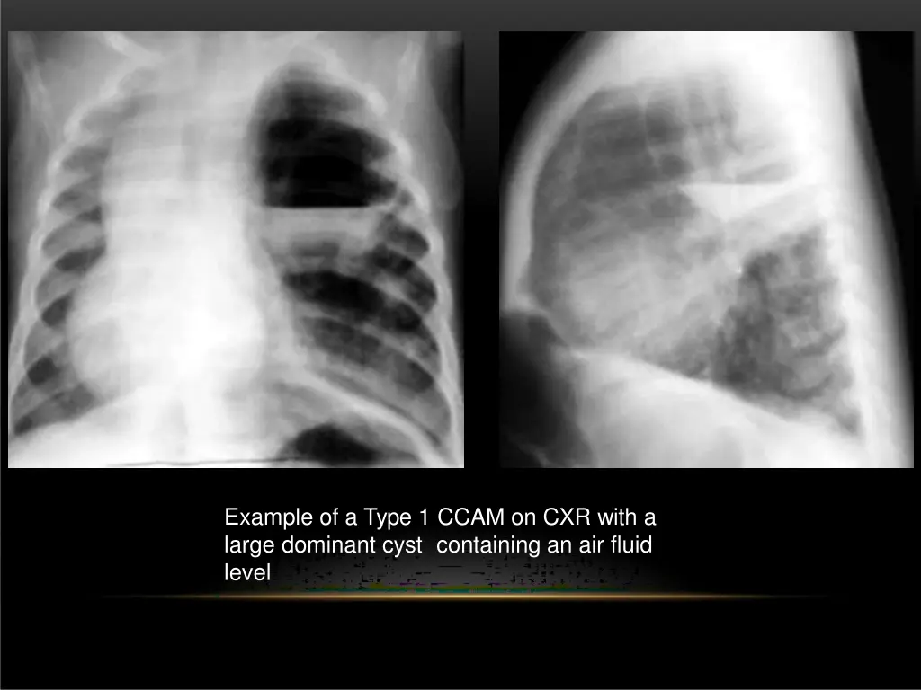 example of a type 1 ccam on cxr with a large