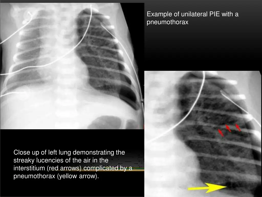 example of unilateral pie with a pneumothorax