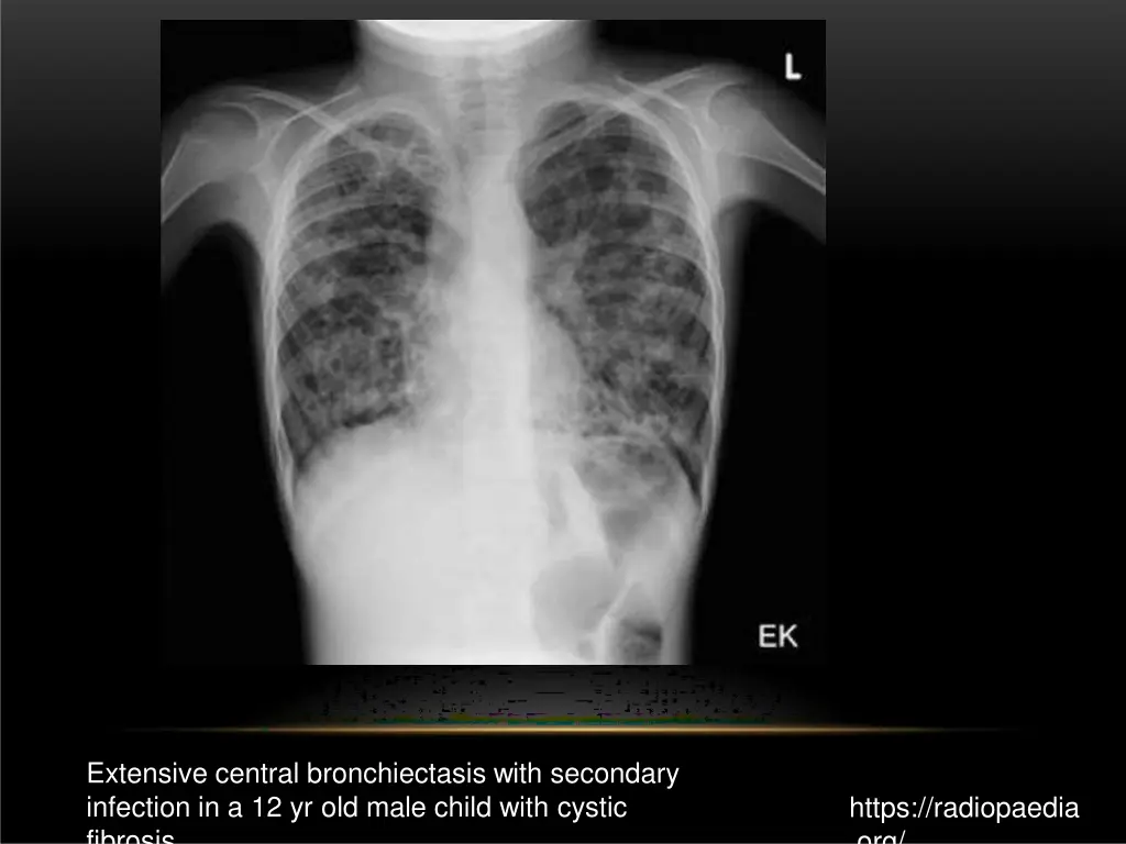 extensive central bronchiectasis with secondary