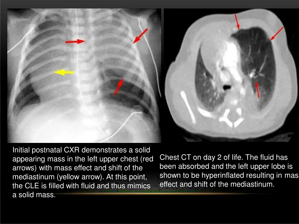 initial postnatal cxr demonstrates a solid