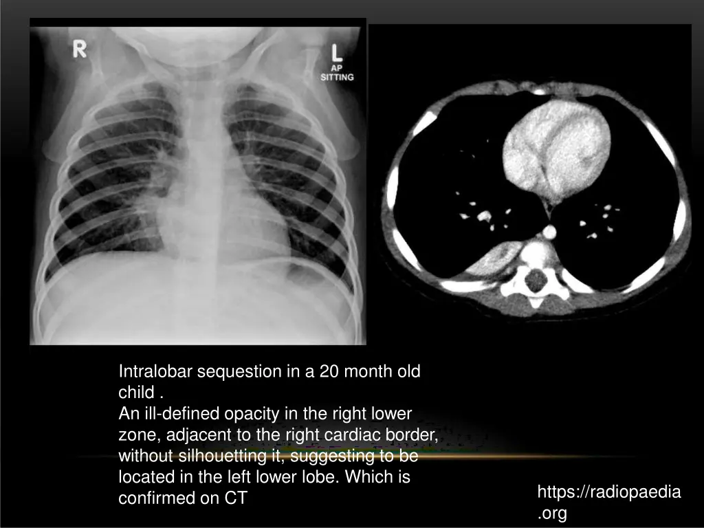 intralobar sequestion in a 20 month old child