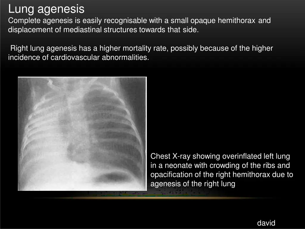 lung agenesis complete agenesis is easily