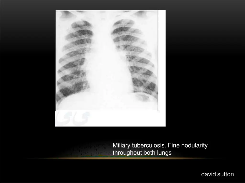 miliary tuberculosis fine nodularity throughout