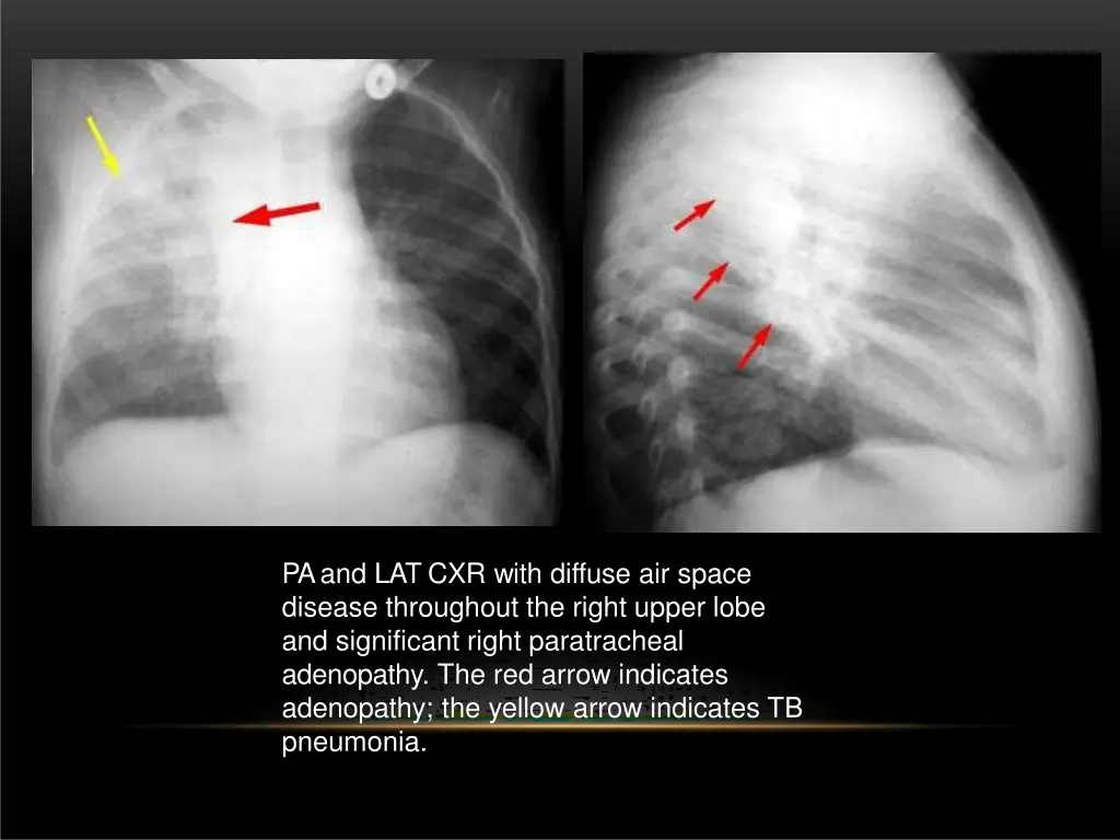 pa and lat cxr with diffuse air space disease