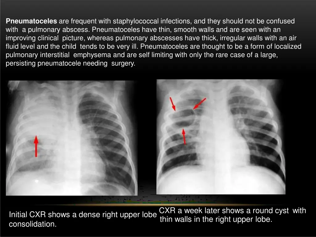 pneumatoceles are frequent with staphylococcal