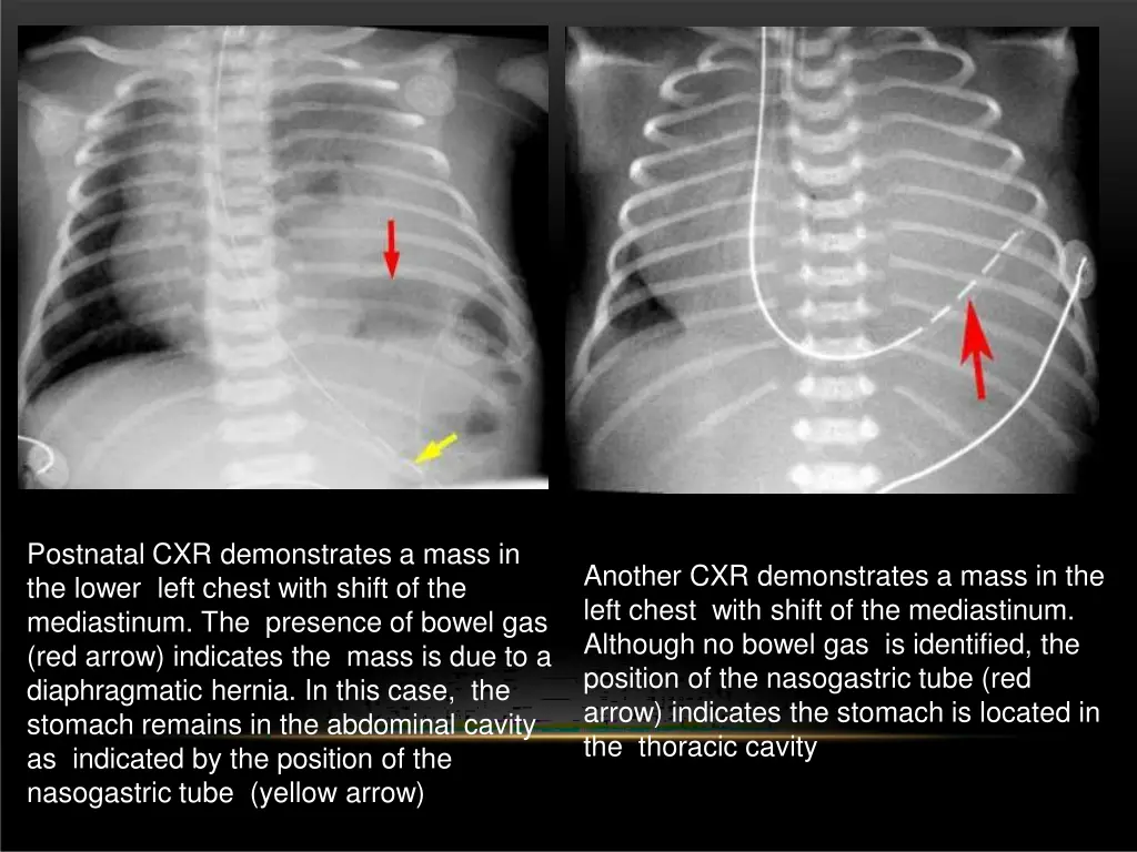 postnatal cxr demonstrates a mass in the lower
