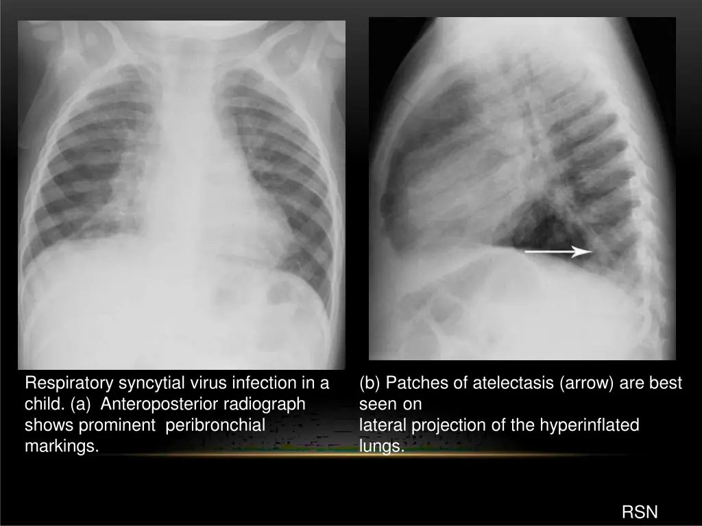 respiratory syncytial virus infection in a child