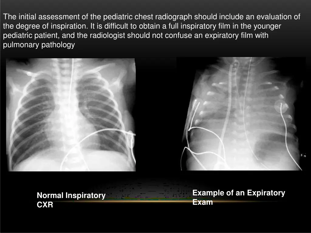 the initial assessment of the pediatric chest
