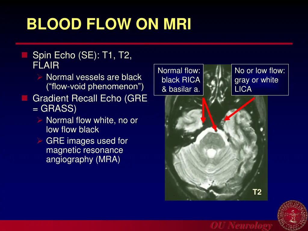 blood flow on mri