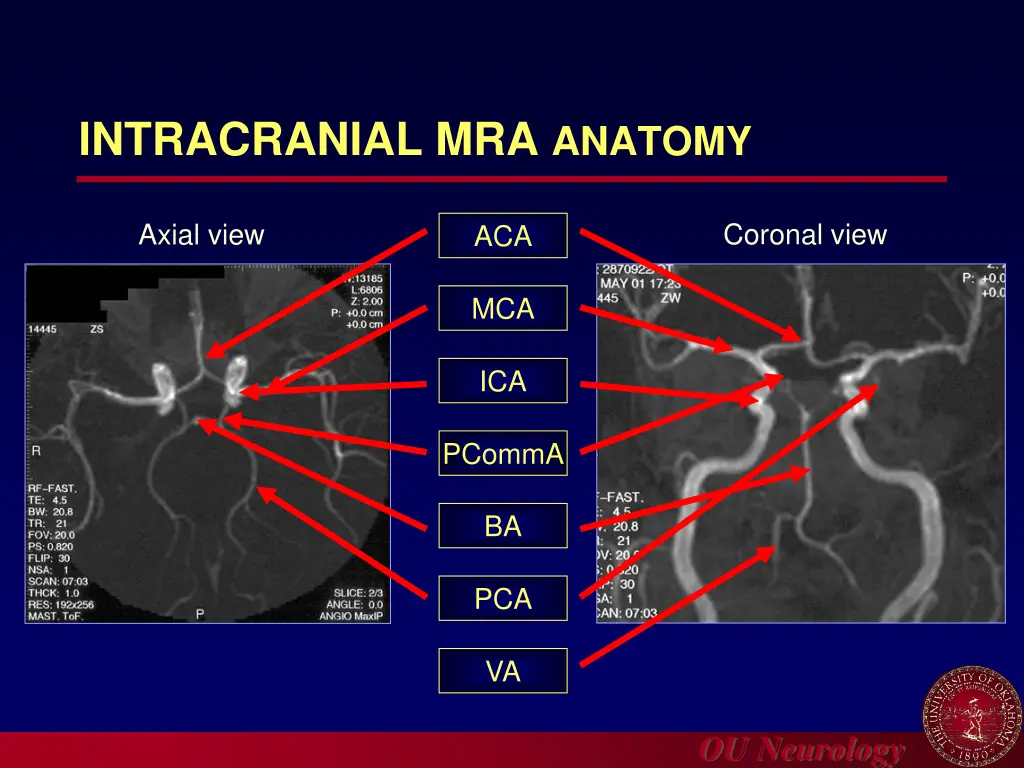 intracranial mra anatomy