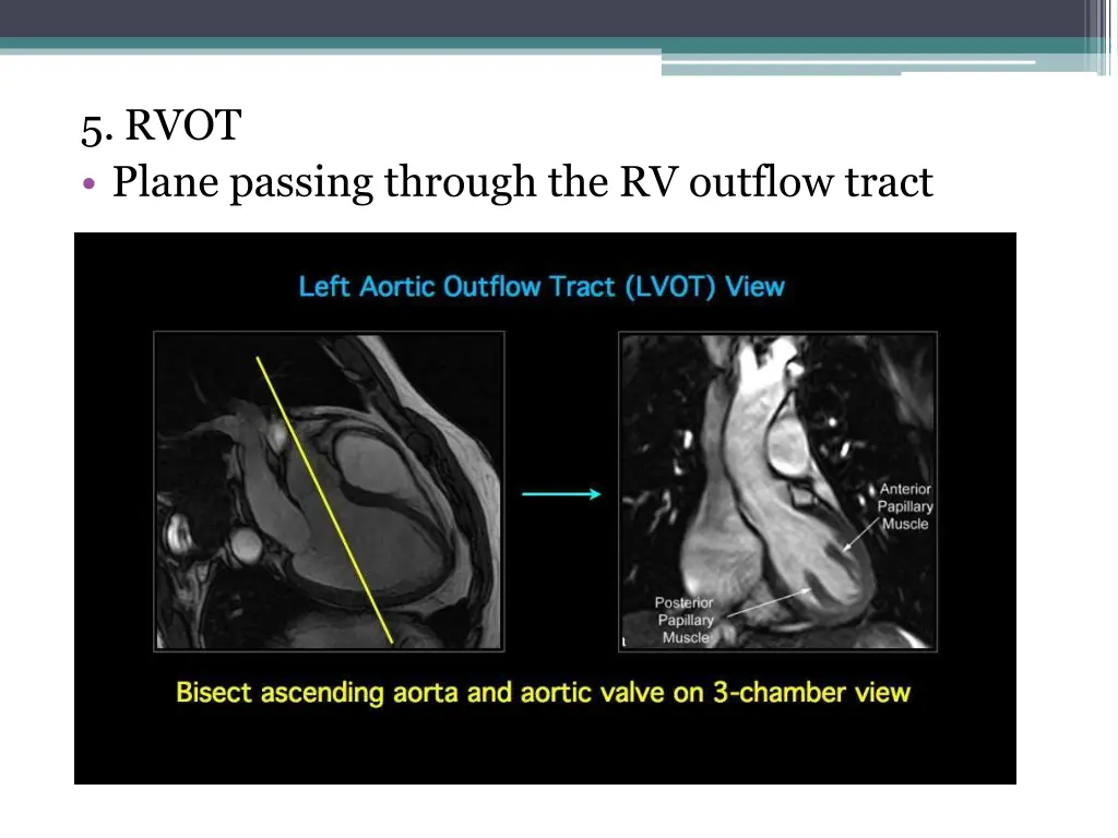 5 rvot plane passing through the rv outflow tract