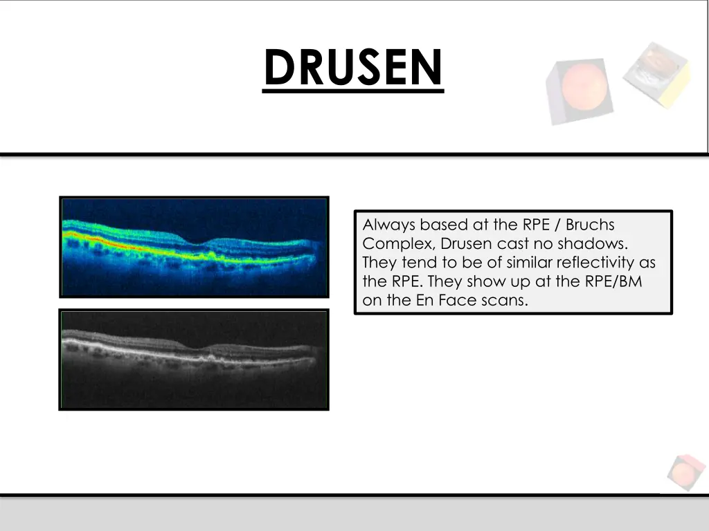 drusen
