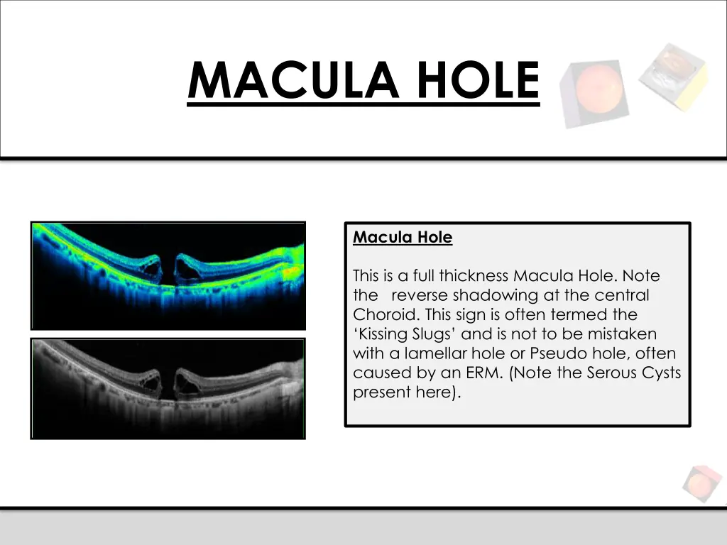 macula hole