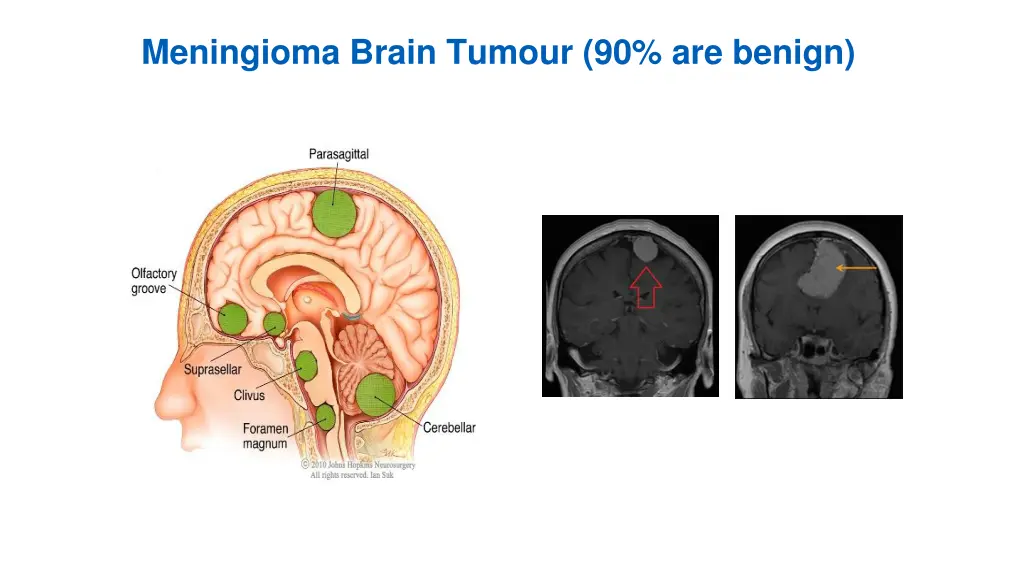 meningioma brain tumour 90 are benign