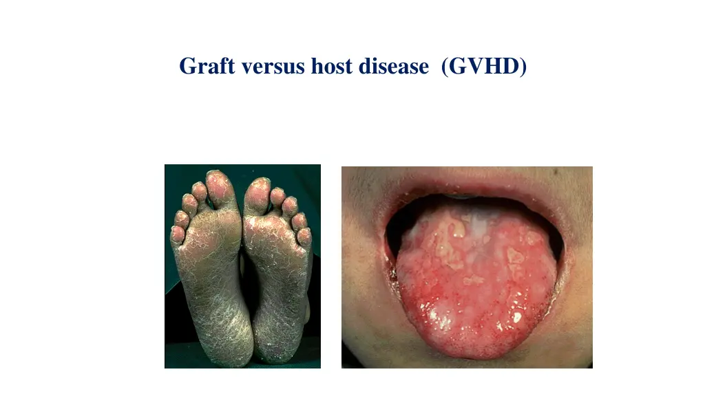 graft versus host disease gvhd