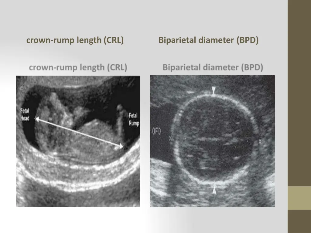 crown rump length crl