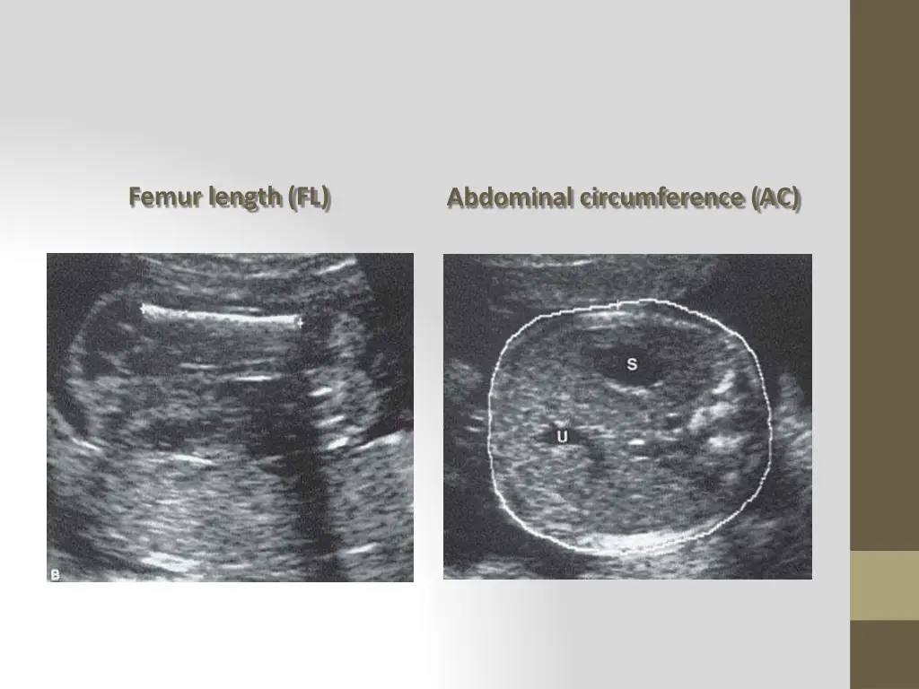 femur length fl