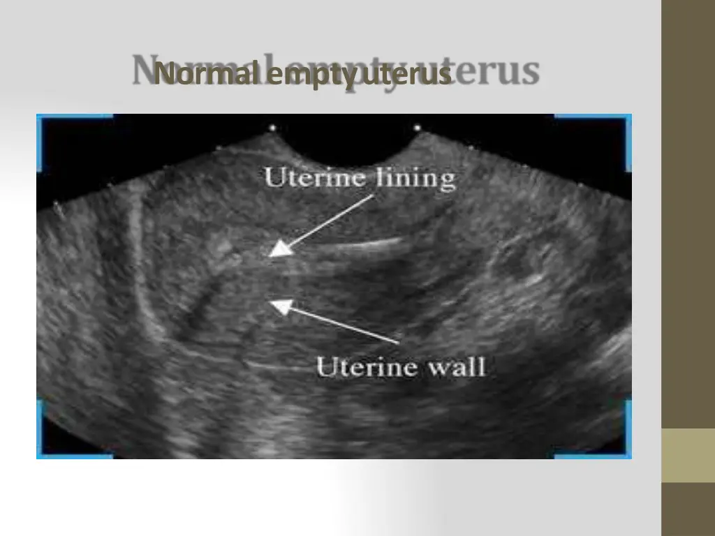 normal empty uterus