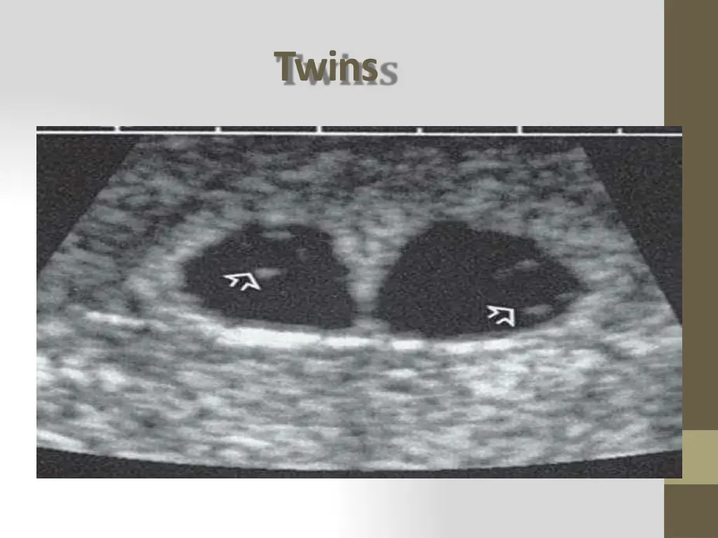 twins