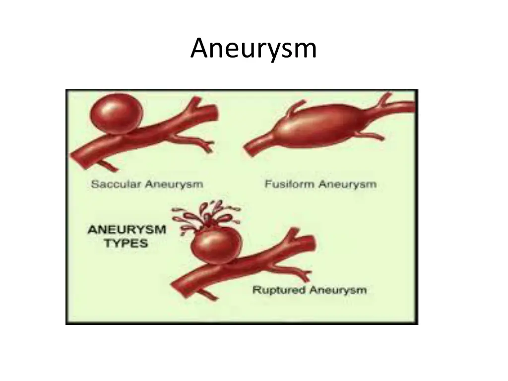 aneurysm 1