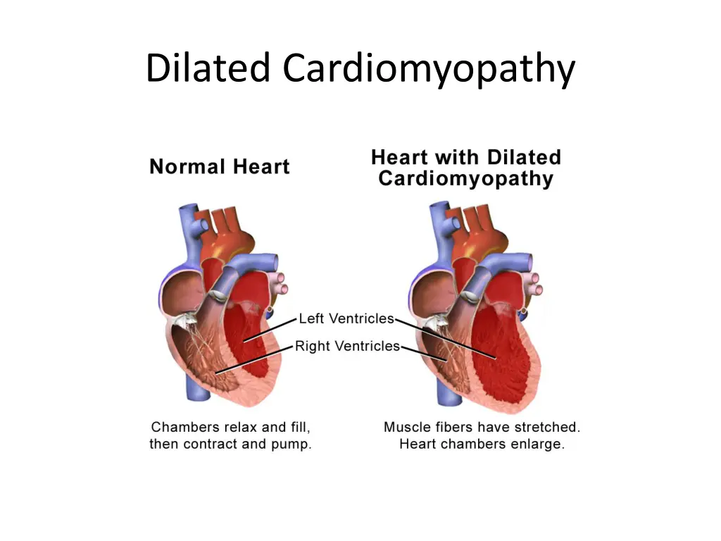 dilated cardiomyopathy