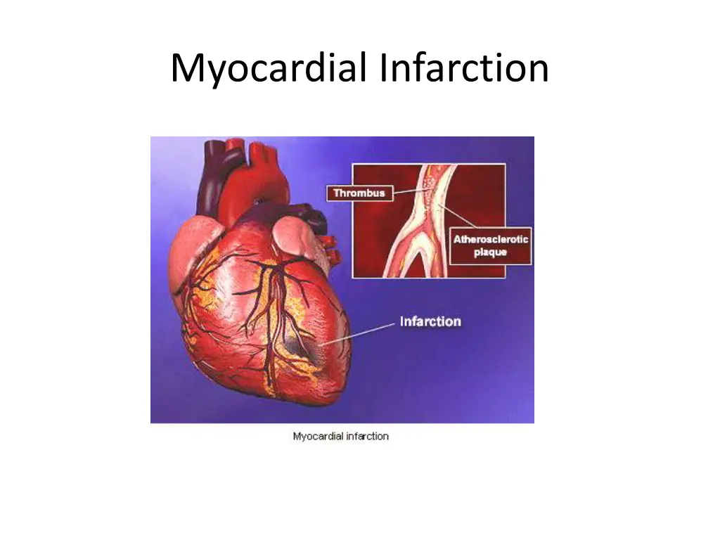 myocardial infarction