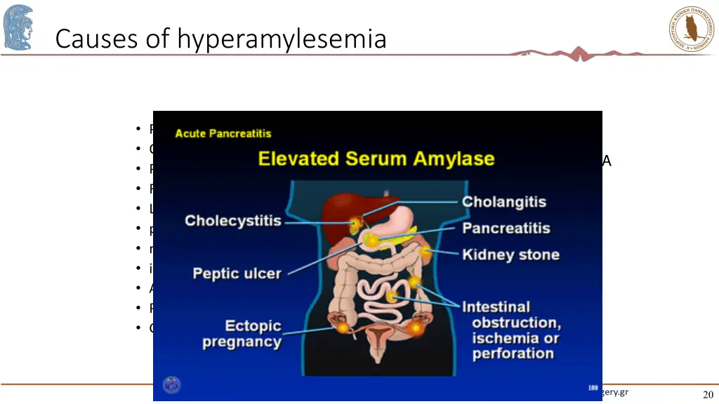 causes of hyperamylesemia