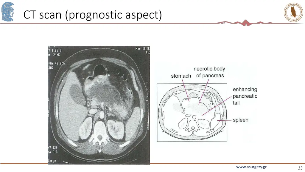 ct scan prognostic aspect 1