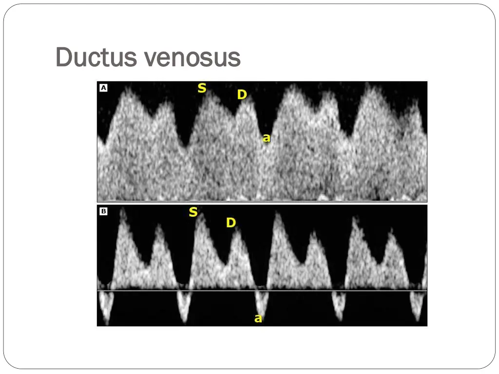 ductus ductus venosus venosus