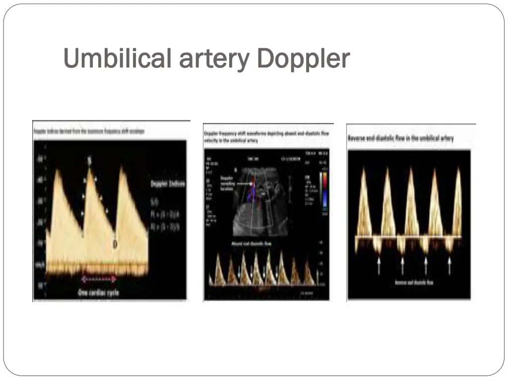 umbilical artery doppler umbilical artery doppler