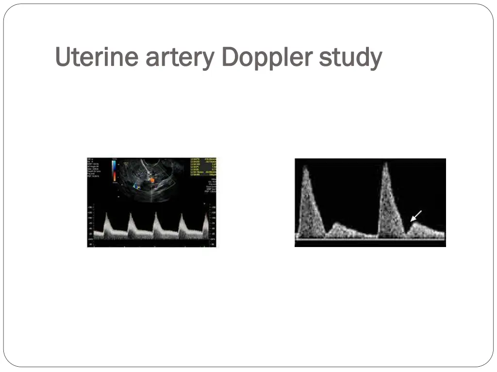 uterine artery doppler study uterine artery 1