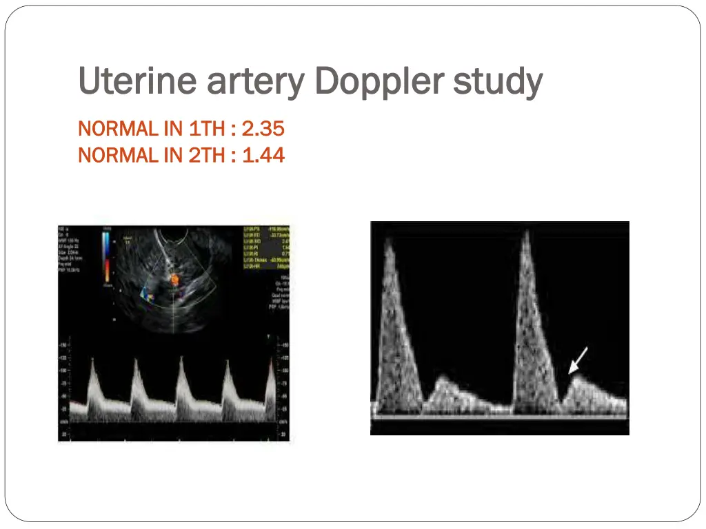 uterine artery doppler study uterine artery