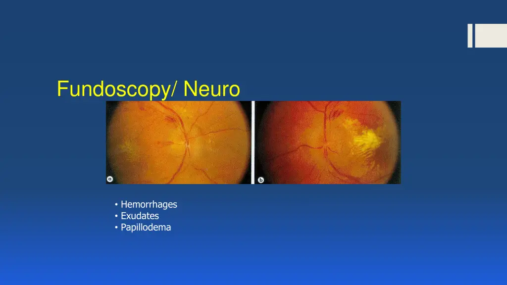 fundoscopy neuro
