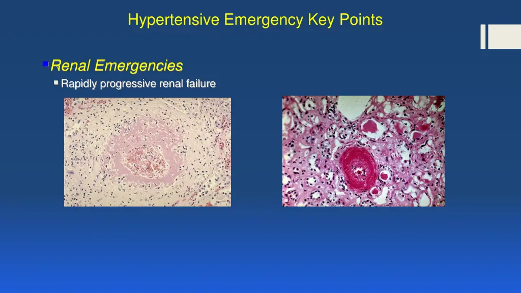 hypertensive emergency key points 1