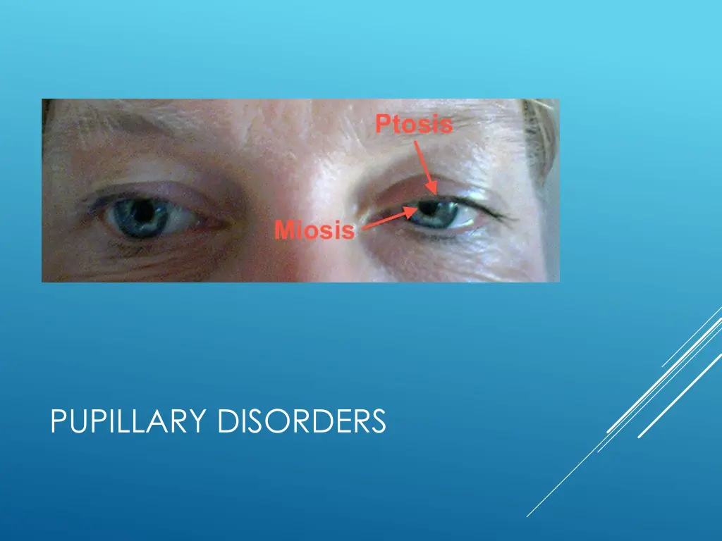 pupillary disorders 2