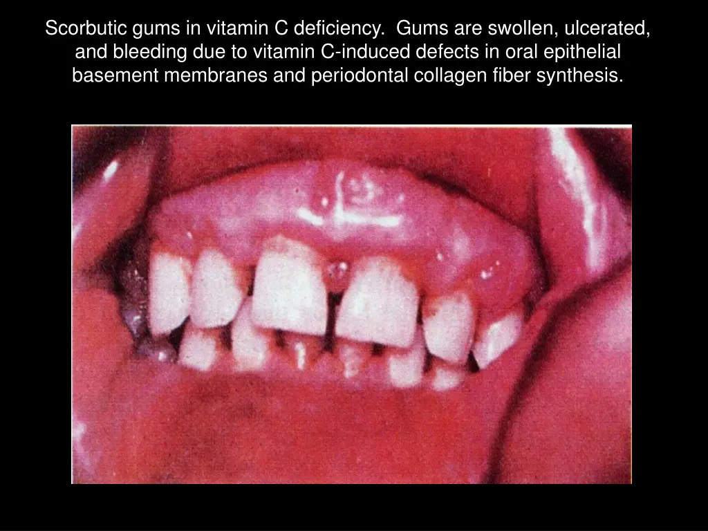 scorbutic gums in vitamin c deficiency gums