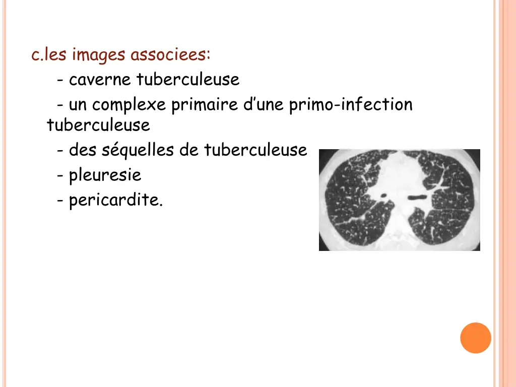 c les images associees caverne tuberculeuse