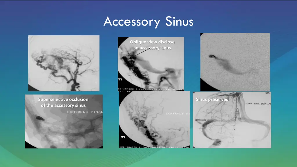 accessory sinus