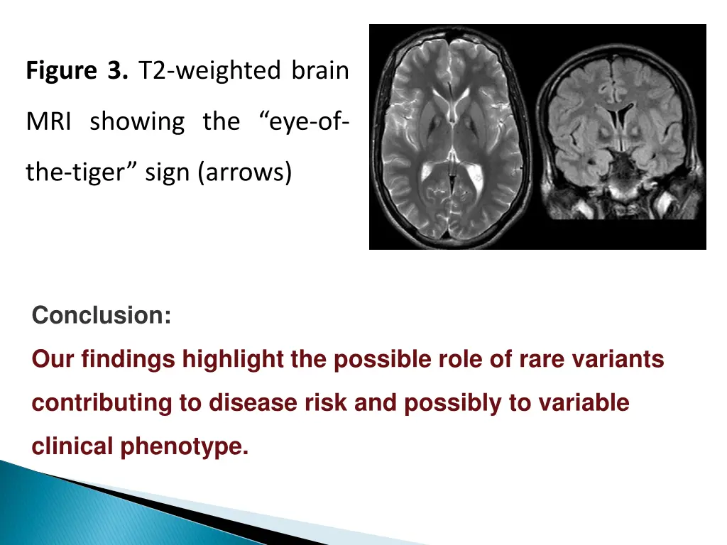 figure 3 t2 weighted brain