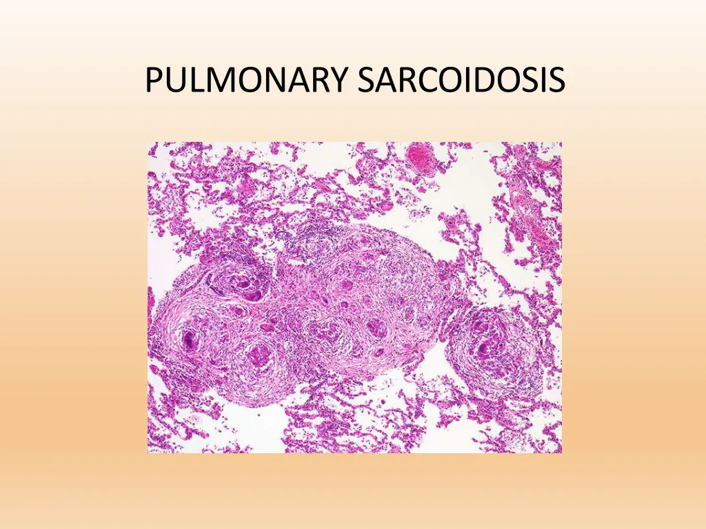pulmonary sarcoidosis