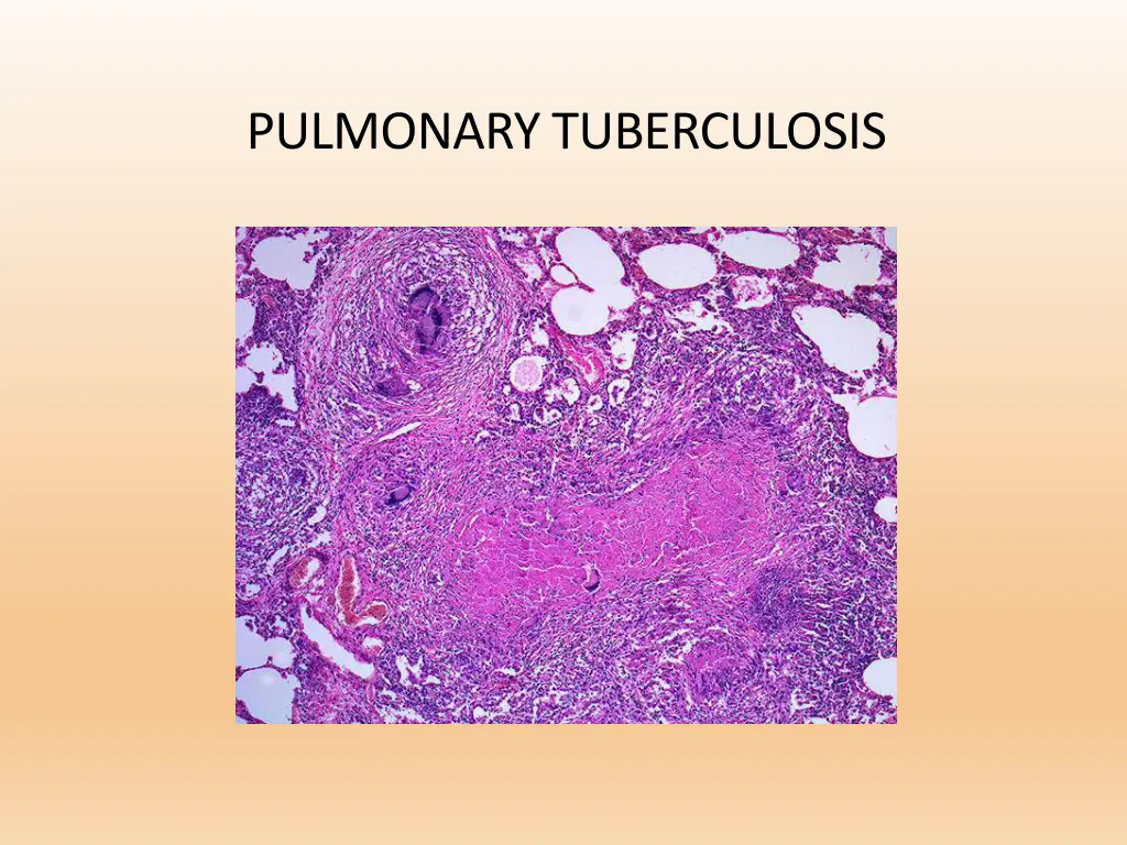 pulmonary tuberculosis
