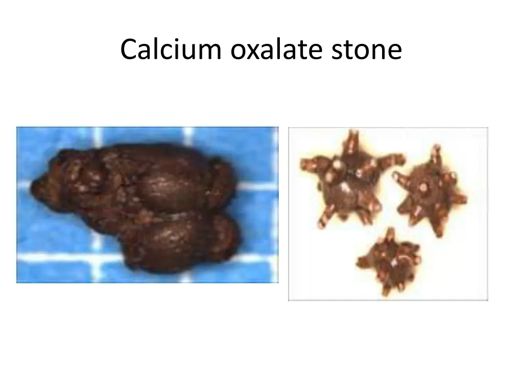 calcium oxalate stone