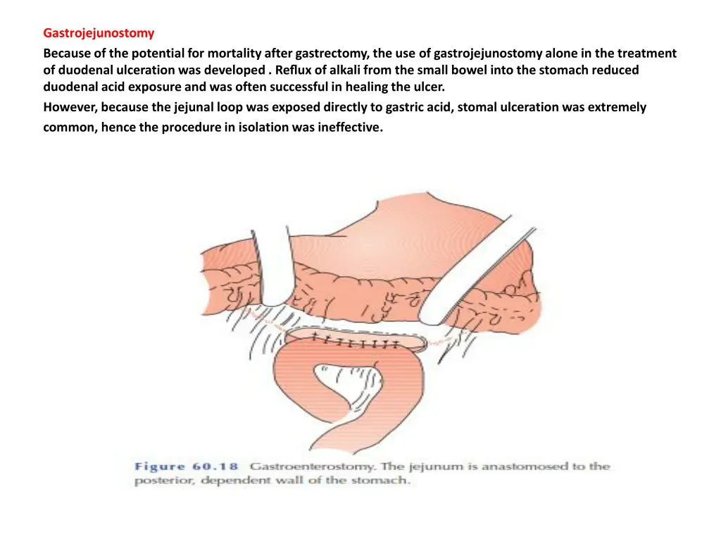 gastrojejunostomy because of the potential