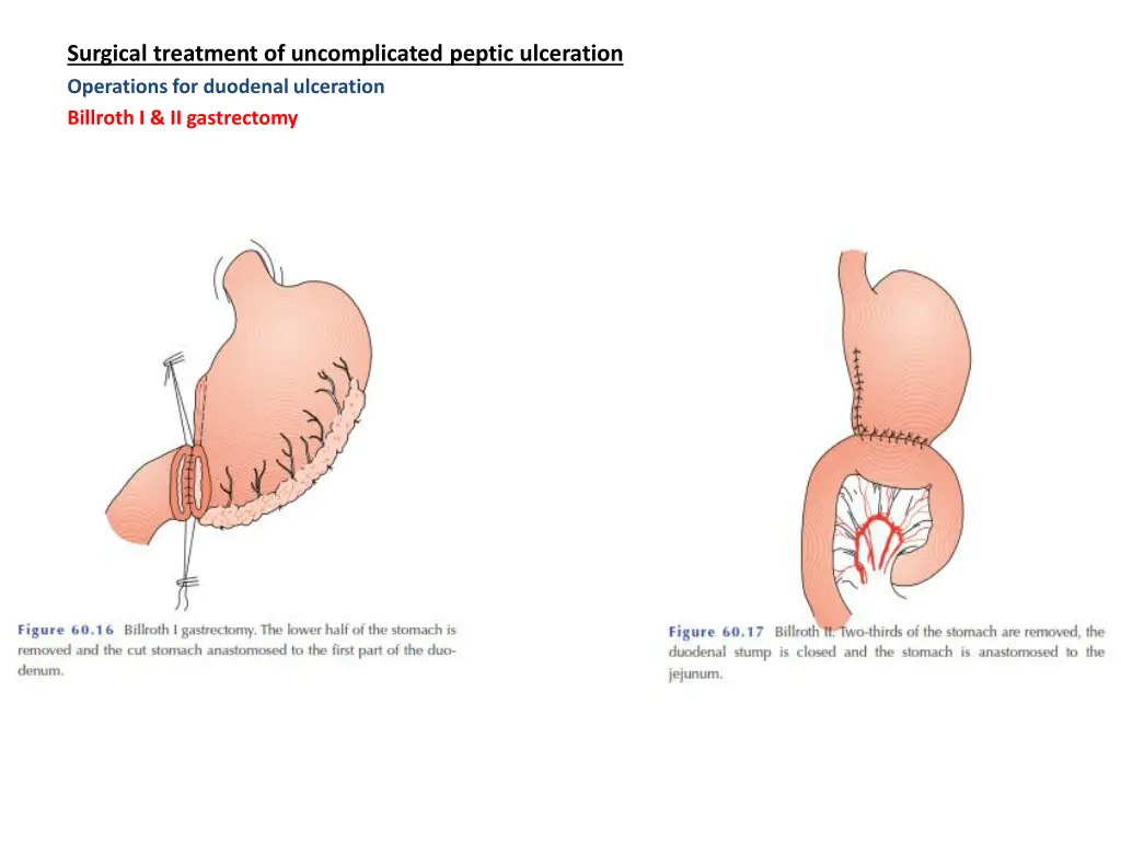 surgical treatment of uncomplicated peptic
